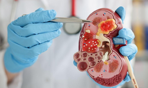 Pediatric Kidney Stones Treatment in Nagpur